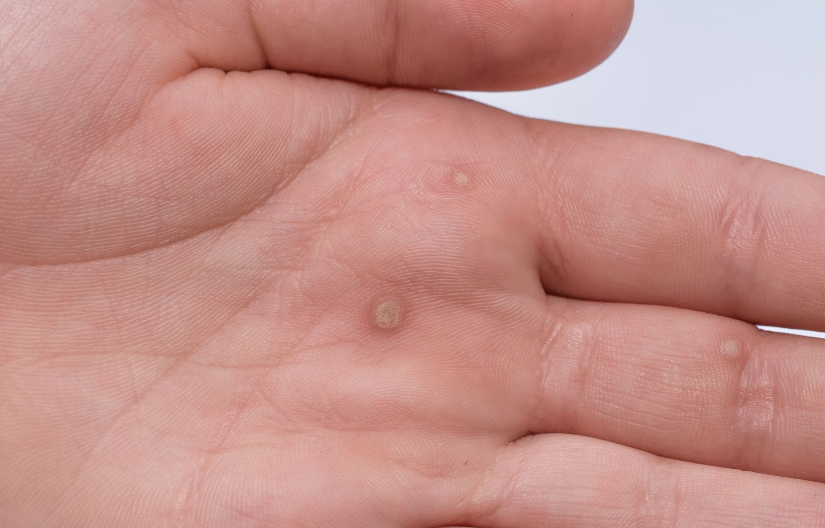 Hpv warts on fingers - What are Warts? (Verruca Vulgaris) hpv virus zyste Hpv warts on finger