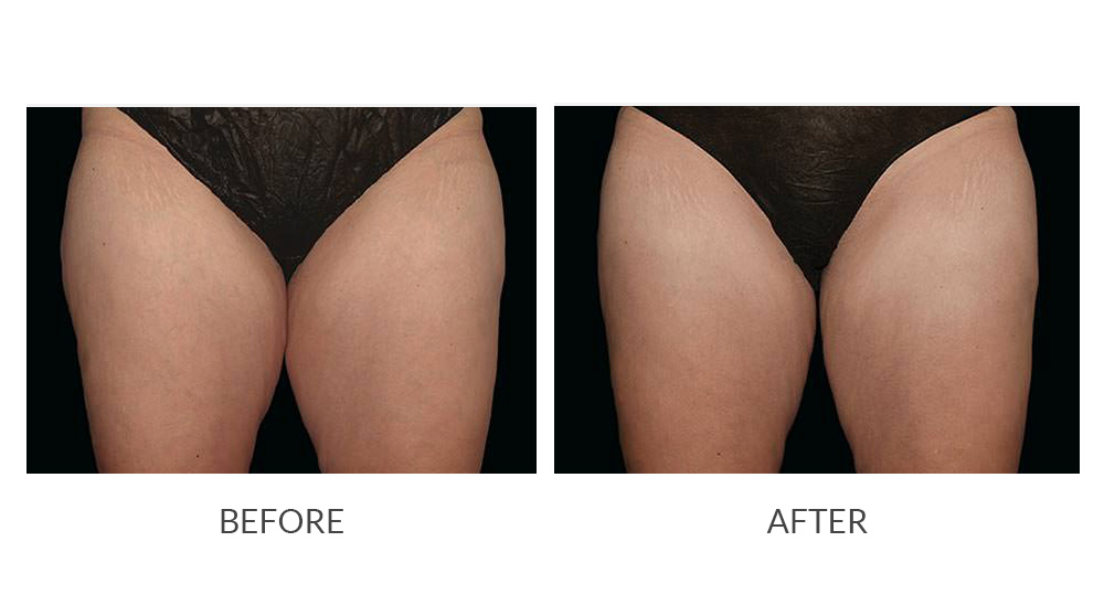 Before and after thigh results