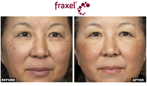 Before and after results for Fraxel