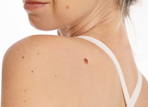 Woman in need of skin growth removal