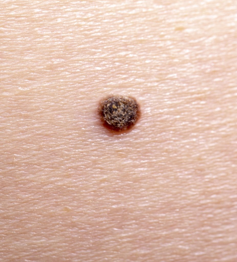 Close-up on melanoma